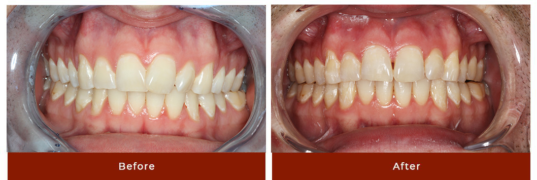 Invisalign Before & After Actual Patient Results