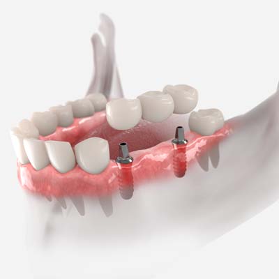 Dental Bridge Dental Implant