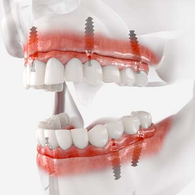 Full Mouth Dental Implants