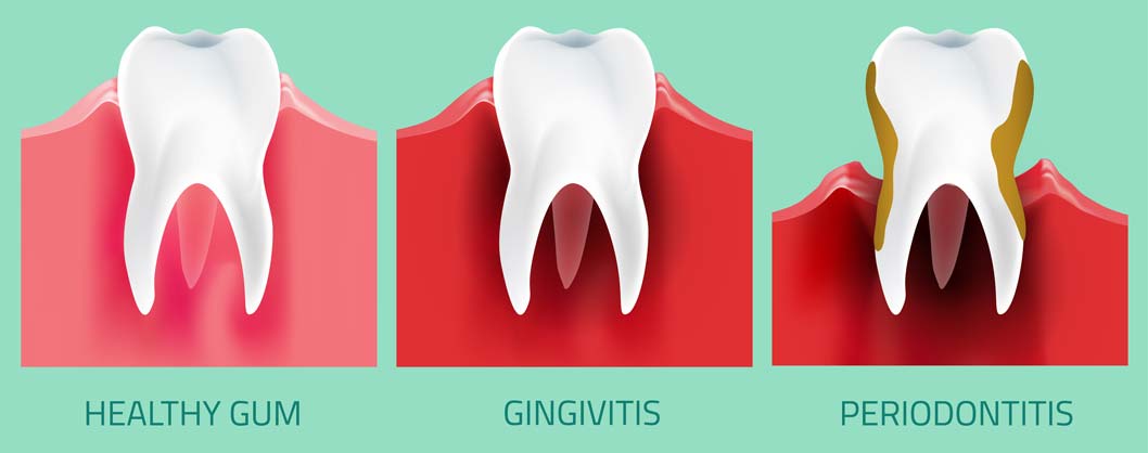 Gum Disease Stages