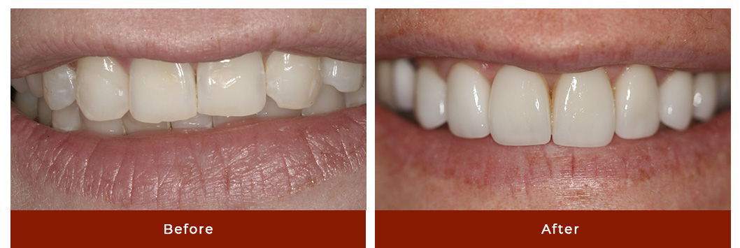 Porcelain Veneers Before After