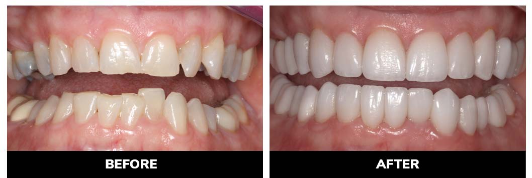 Porcelain Veneers Patient Before & After the Procedure