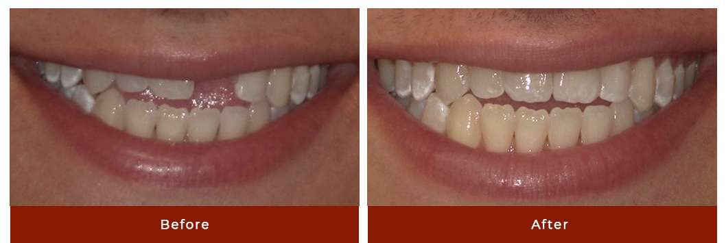 Single Dental Implant Before After