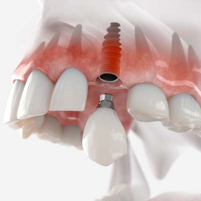 Single Tooth Dental Implant