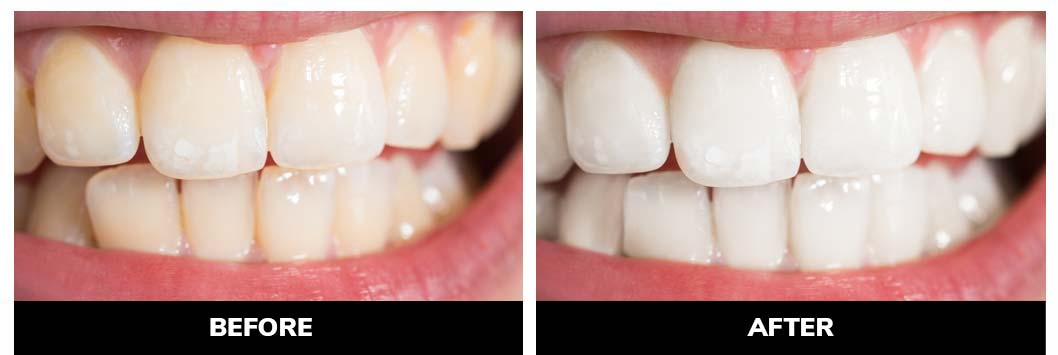 Teeth Whitening Before & After