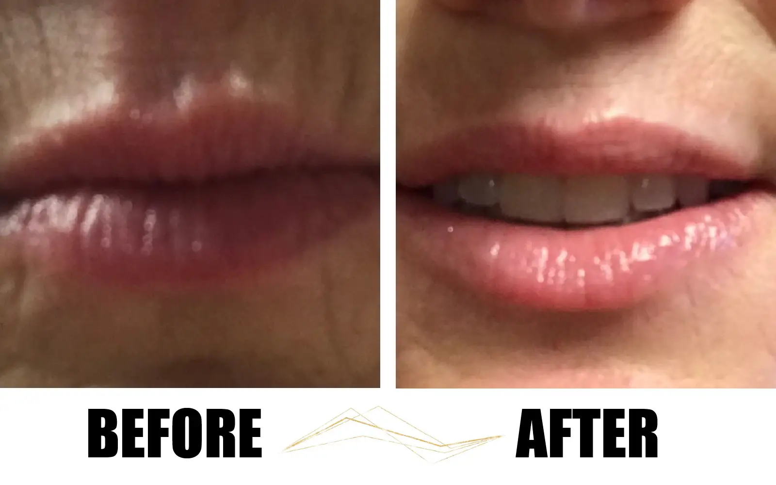 Lip Flip Before/After Botox