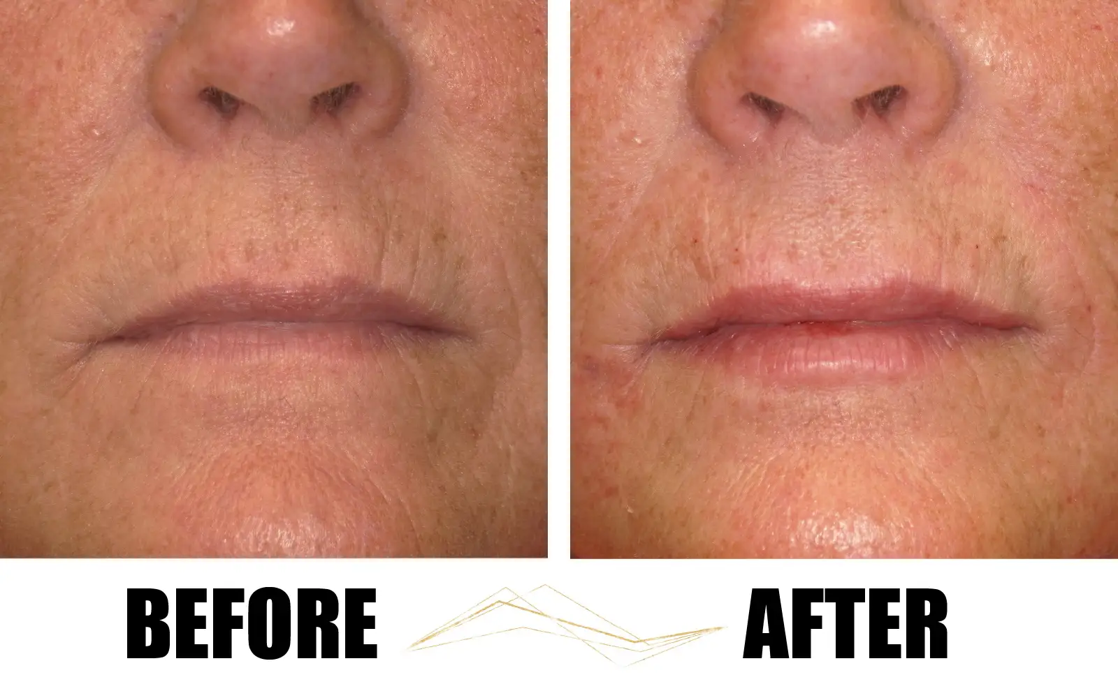 Lips Before/After Filler